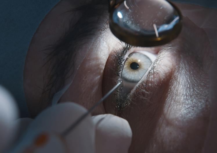 Cataract surgery