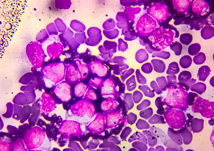 Acute lymphoblastic leukemia (ALL), Mature B-cell analysed by light microscope