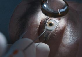 Cataract surgery