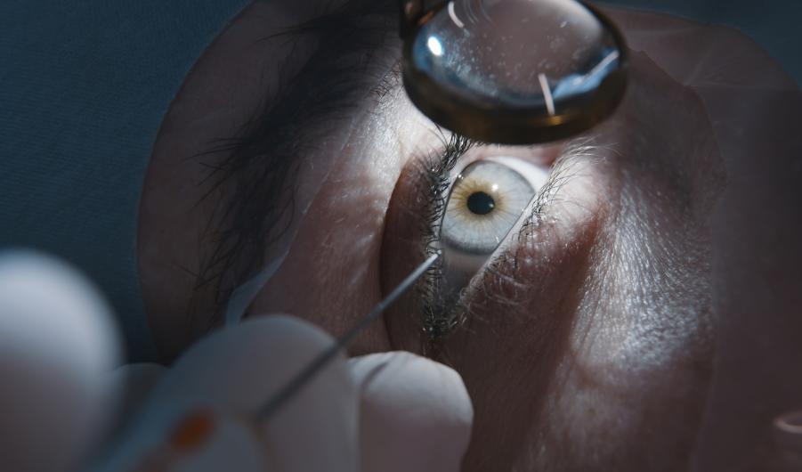Cataract surgery