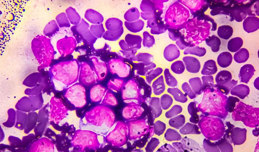 Acute lymphoblastic leukemia (ALL), Mature B-cell analysed by light microscope